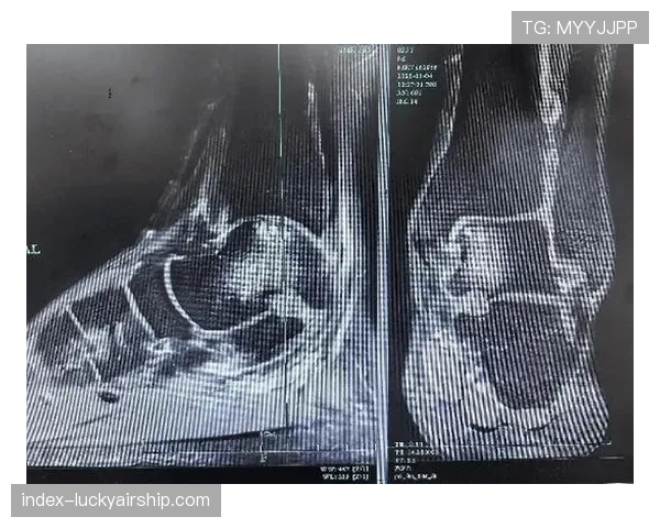 医疗报告：兰斯队突破手脚踝韧带扭伤，预计将缺席剩余赛季